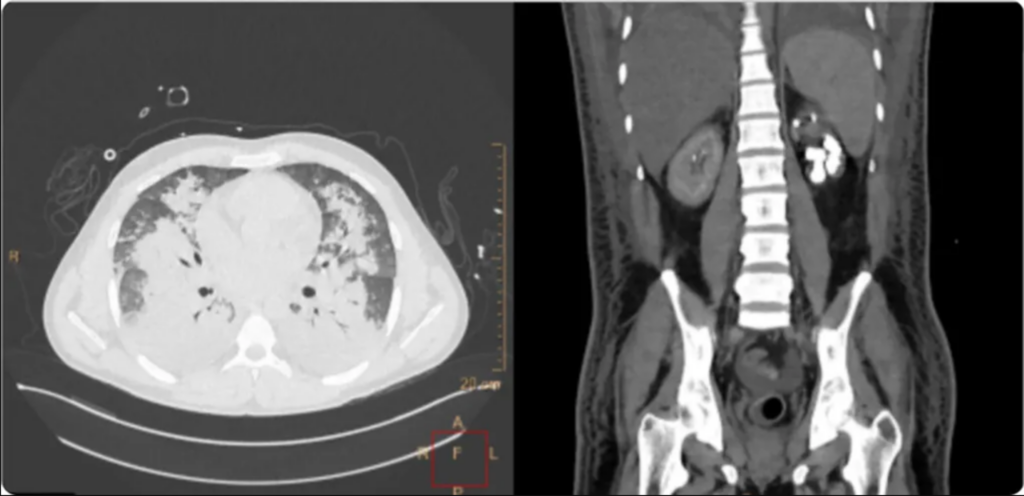 Identifying Cardiac Oxalosis in Primary Hyperoxaluria Type 1