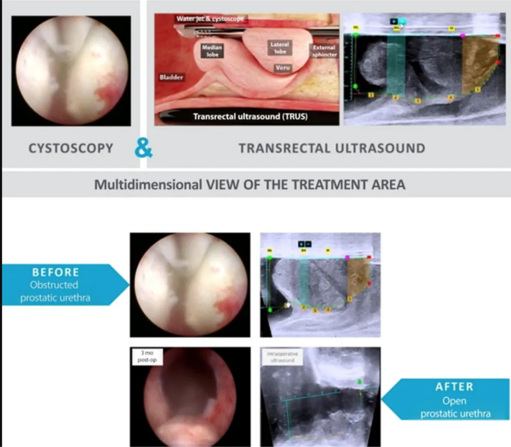 AquaBeam Surgery: King Charles and the Evolution of Minimal Invasive Procedures