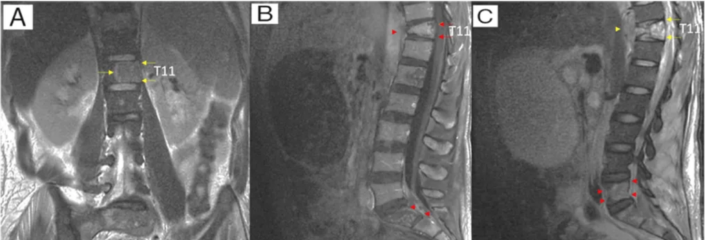 A Case of Gastric Burkitt Lymphoma in HIV/AIDS: Unusual Lymph Node Involvement Explored