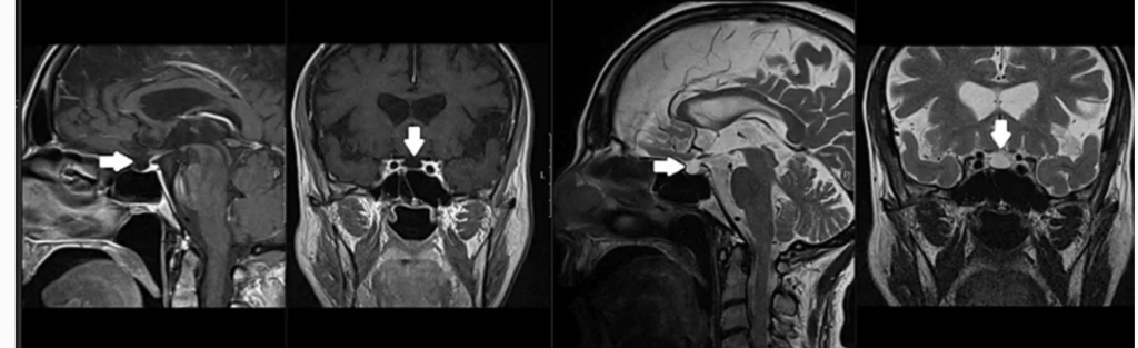 A Case Report on Rare Etiology of Hypopituitarism: Sheehan Syndrome